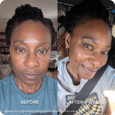 Melasma & Dark Patches