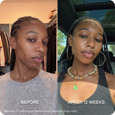 Dark Spots & Marks