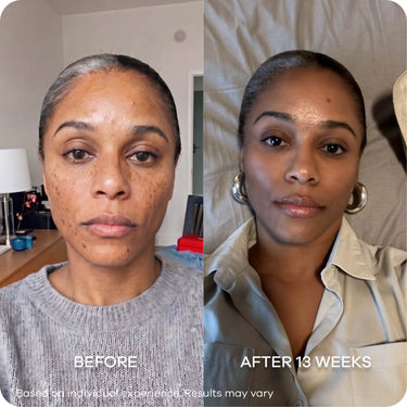 Dark Spots & Marks