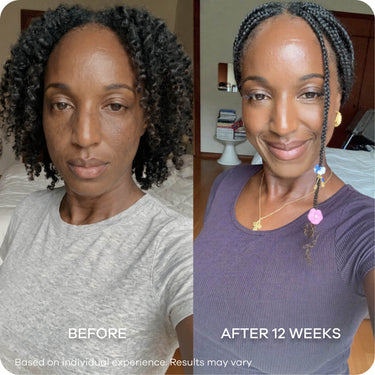 Melasma & Dark Patches