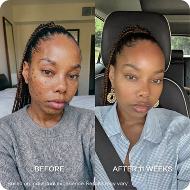 Dark Spots & Marks