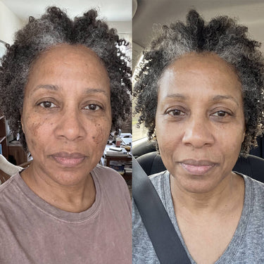 Dark Spots & Marks