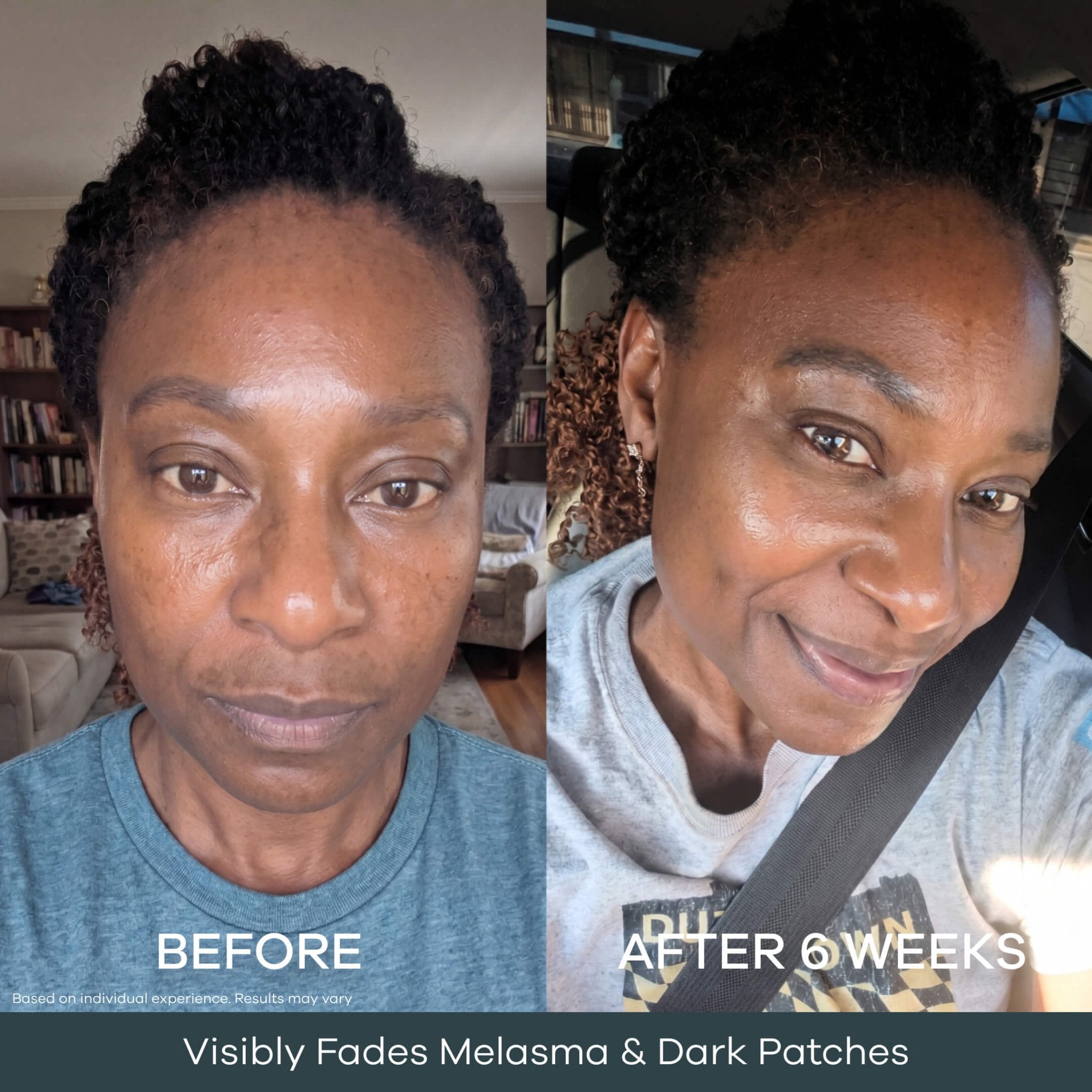 The Micro Infusion Pigmentation System™ - Seranova
