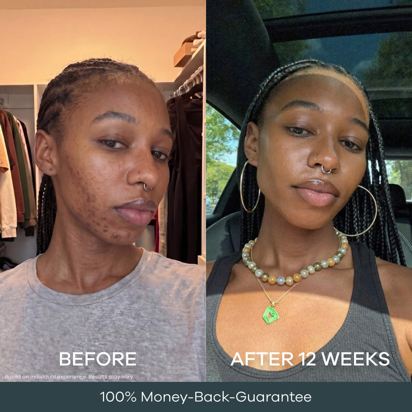 The Micro Infusion Pigmentation System™ - Seranova