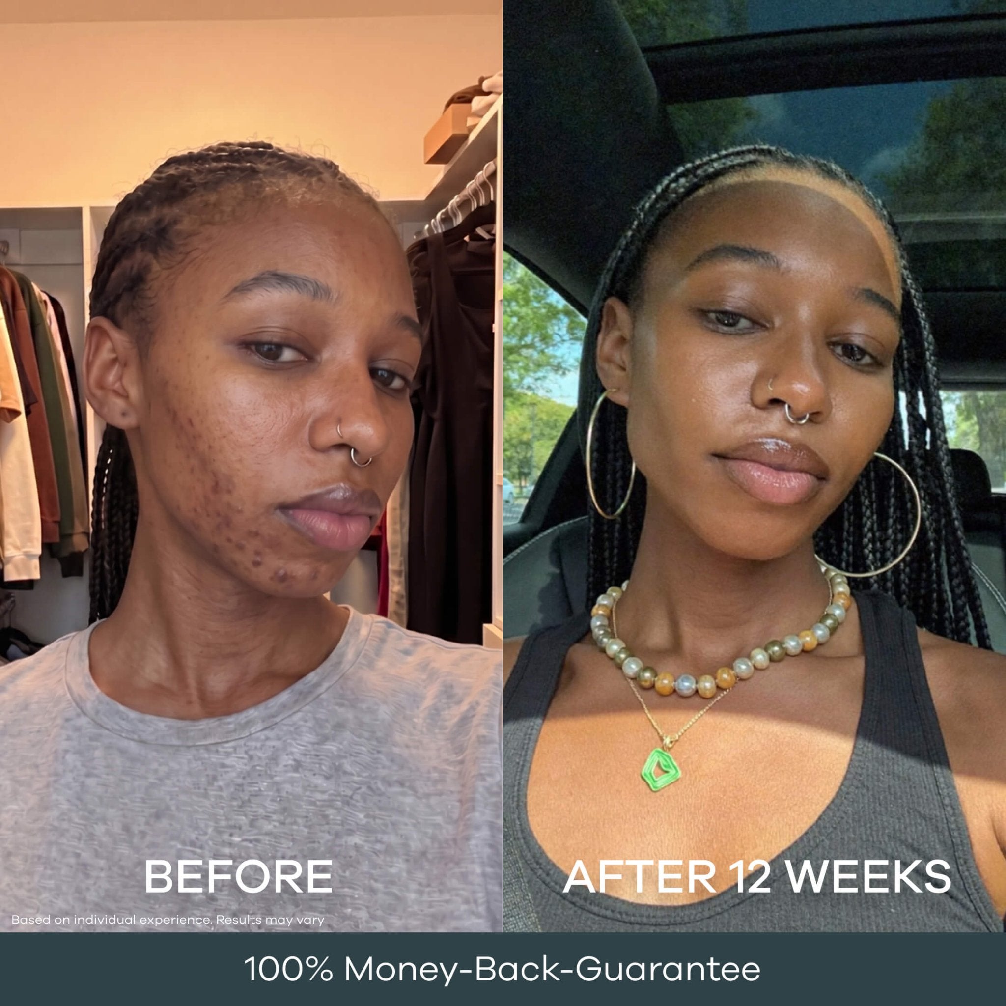 The Micro Infusion Pigmentation System™ - Seranova