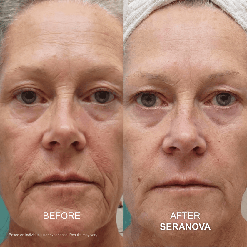 The Micro Infusion System™ - Seranova