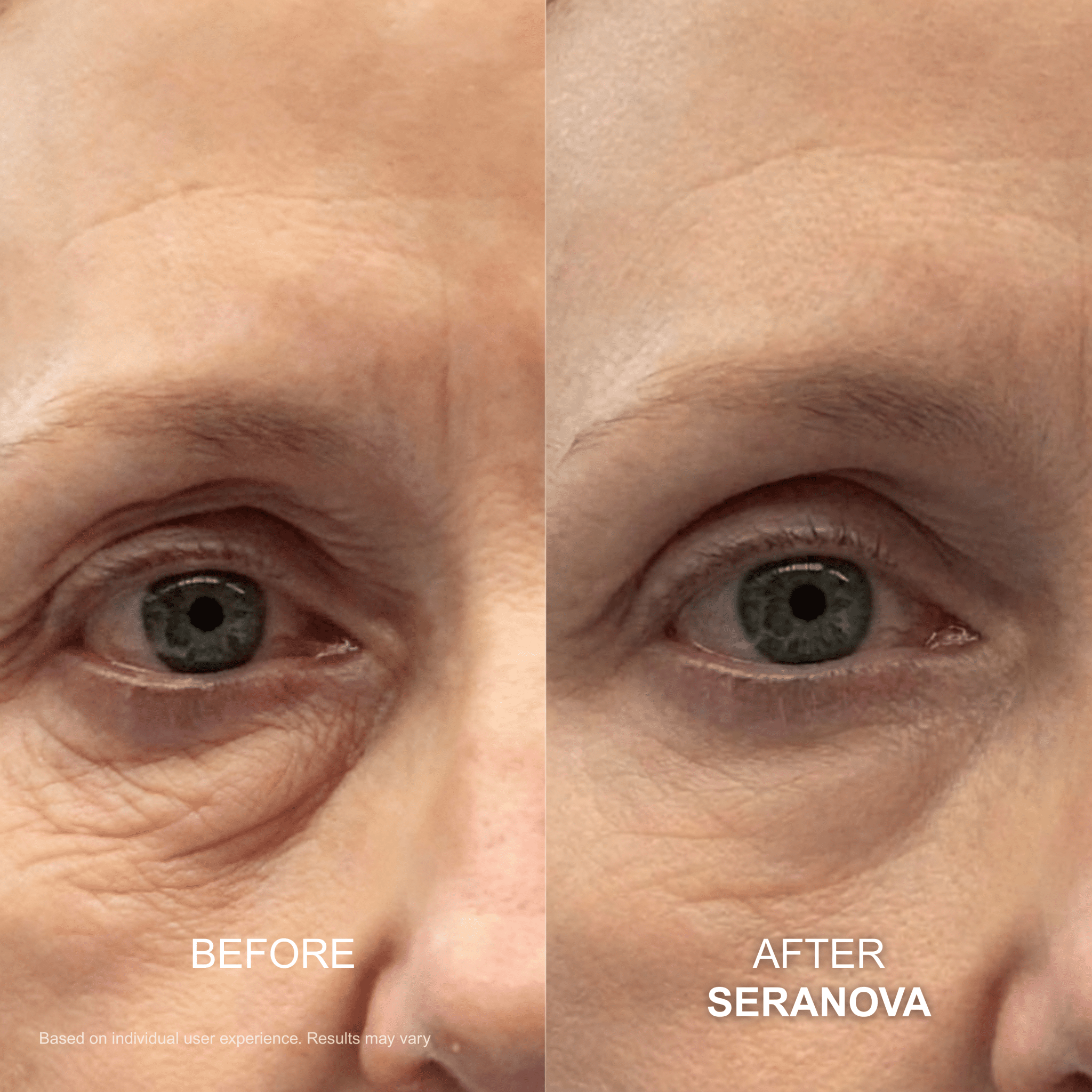 The Micro Infusion System™ - Seranova