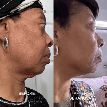 Neck Sagging