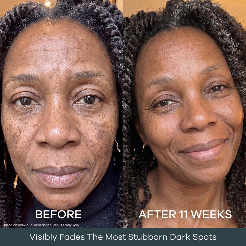 The Micro Infusion System™ Pigmentation For Melanin-Rich Skin - Seranova