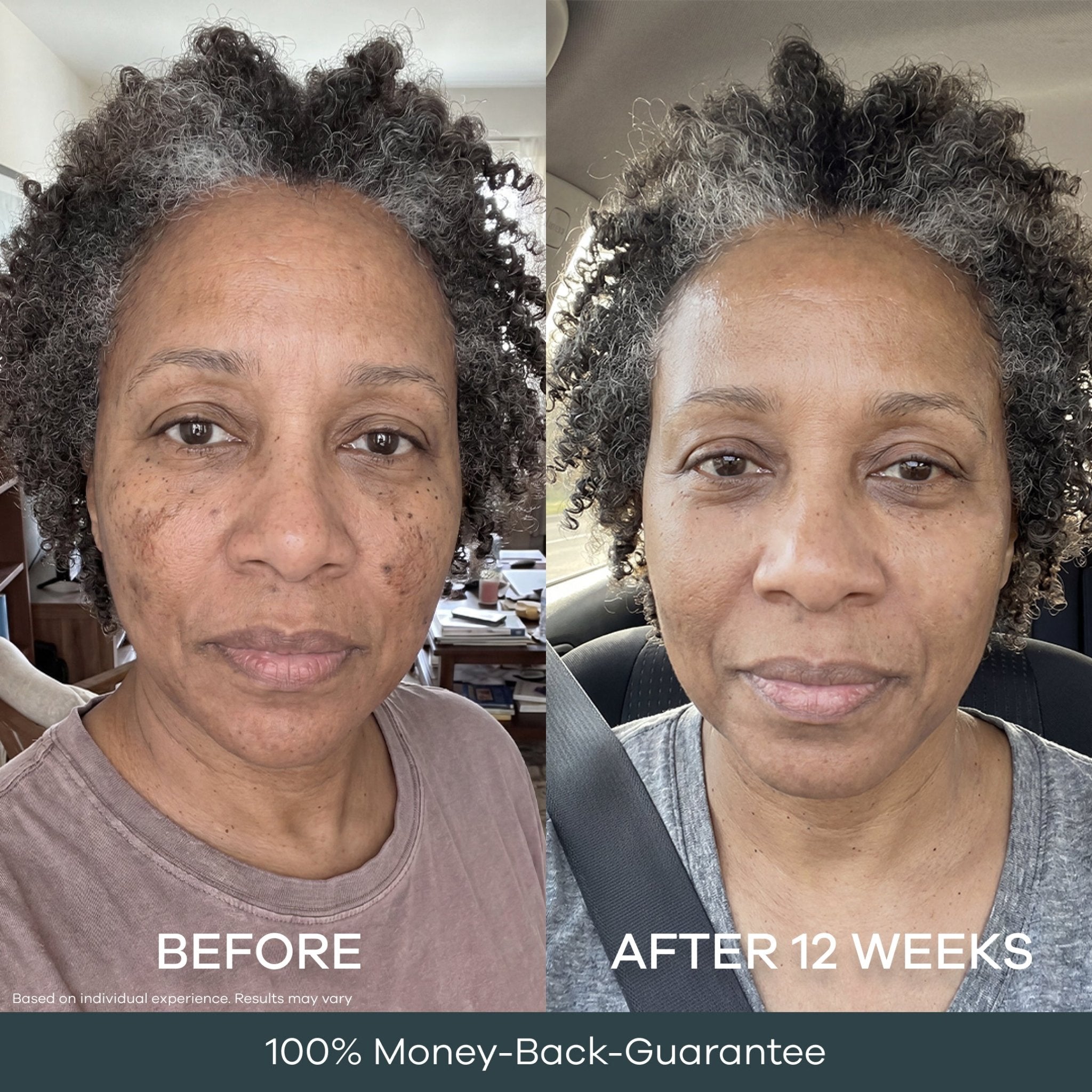 The Micro Infusion System™ Pigmentation For Melanin-Rich Skin - Seranova