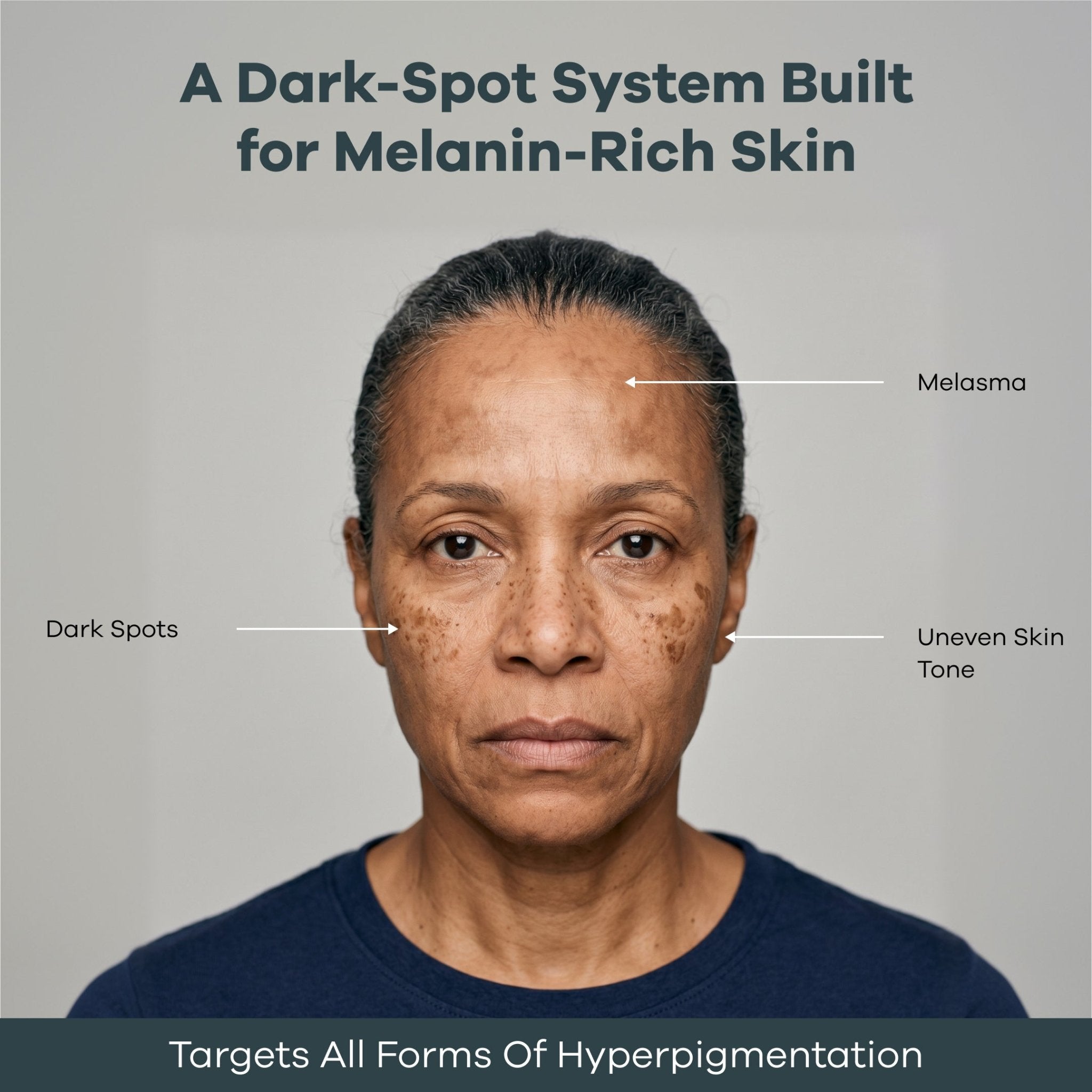 The Micro Infusion System™ Pigmentation For Melanin-Rich Skin - Seranova